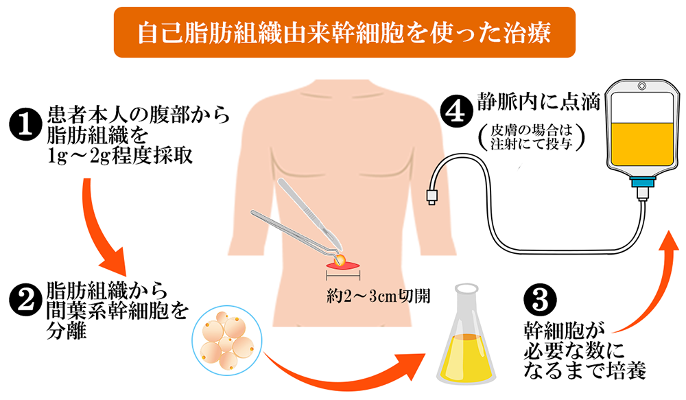 自己脂肪組織由来幹細胞を使った治療